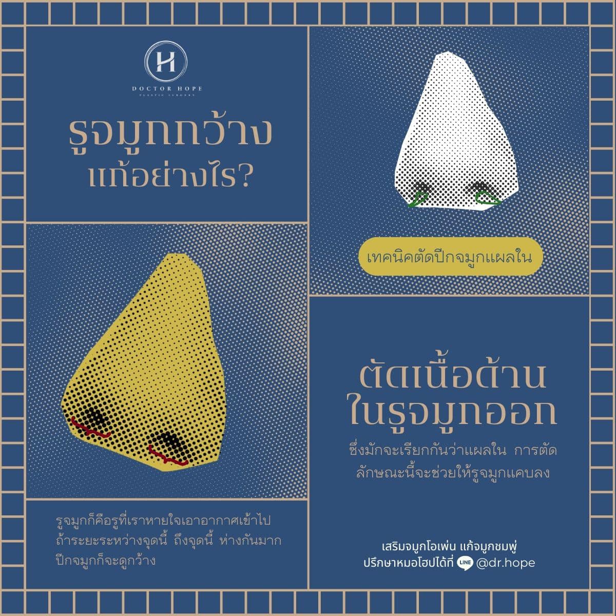 รูจมูกกว้างแก้อย่างไรดี?