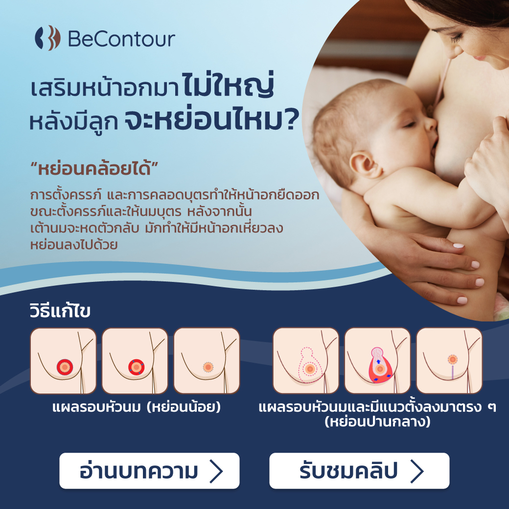 เสริมหน้าอกมาขนาดไม่ใหญ่ ถ้ามีลูกจะหย่อนไหม