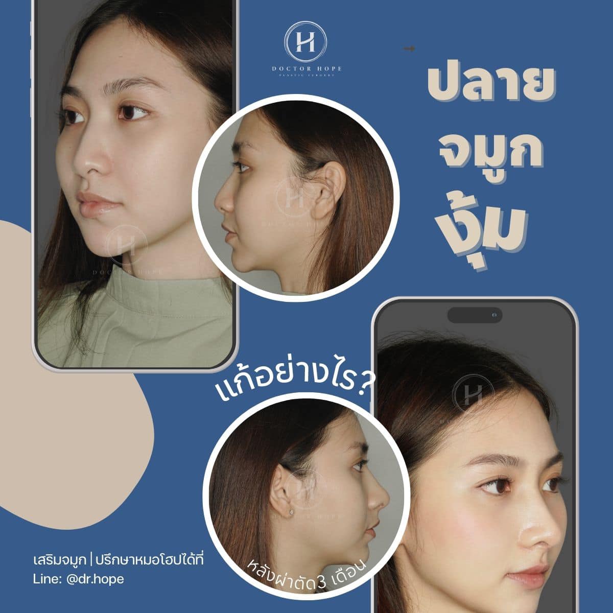 มีปัญหาสันจมูกเอียง ปลายจมูกงุ้มลง