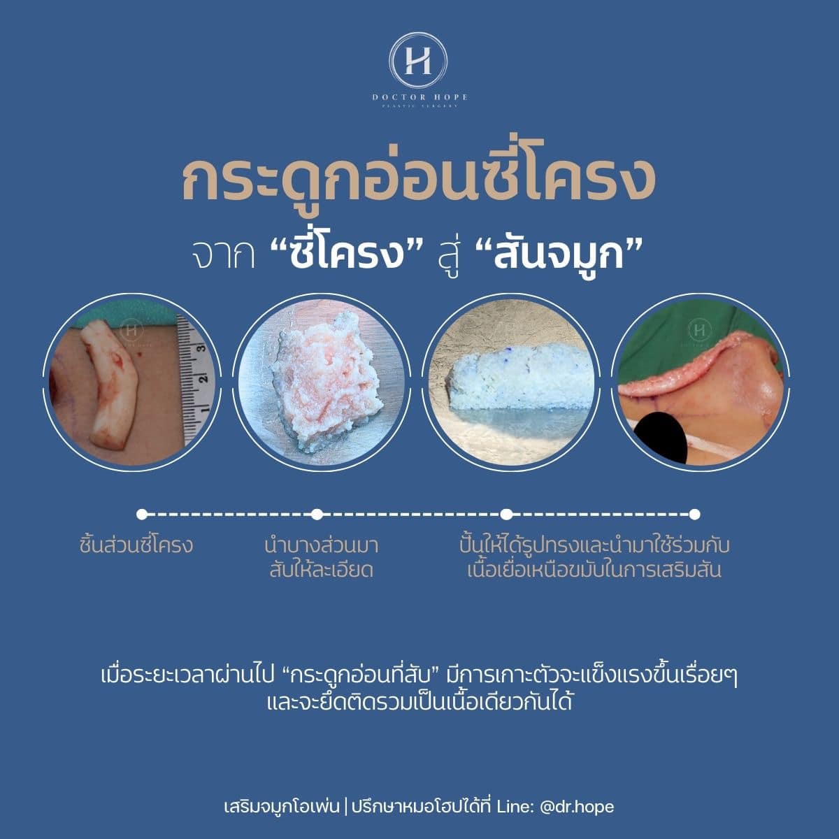 เสริมจมูกโอเพ่นด้วยซี่โครง จาก "ซี่โครง" สู่ "สันจมูก"