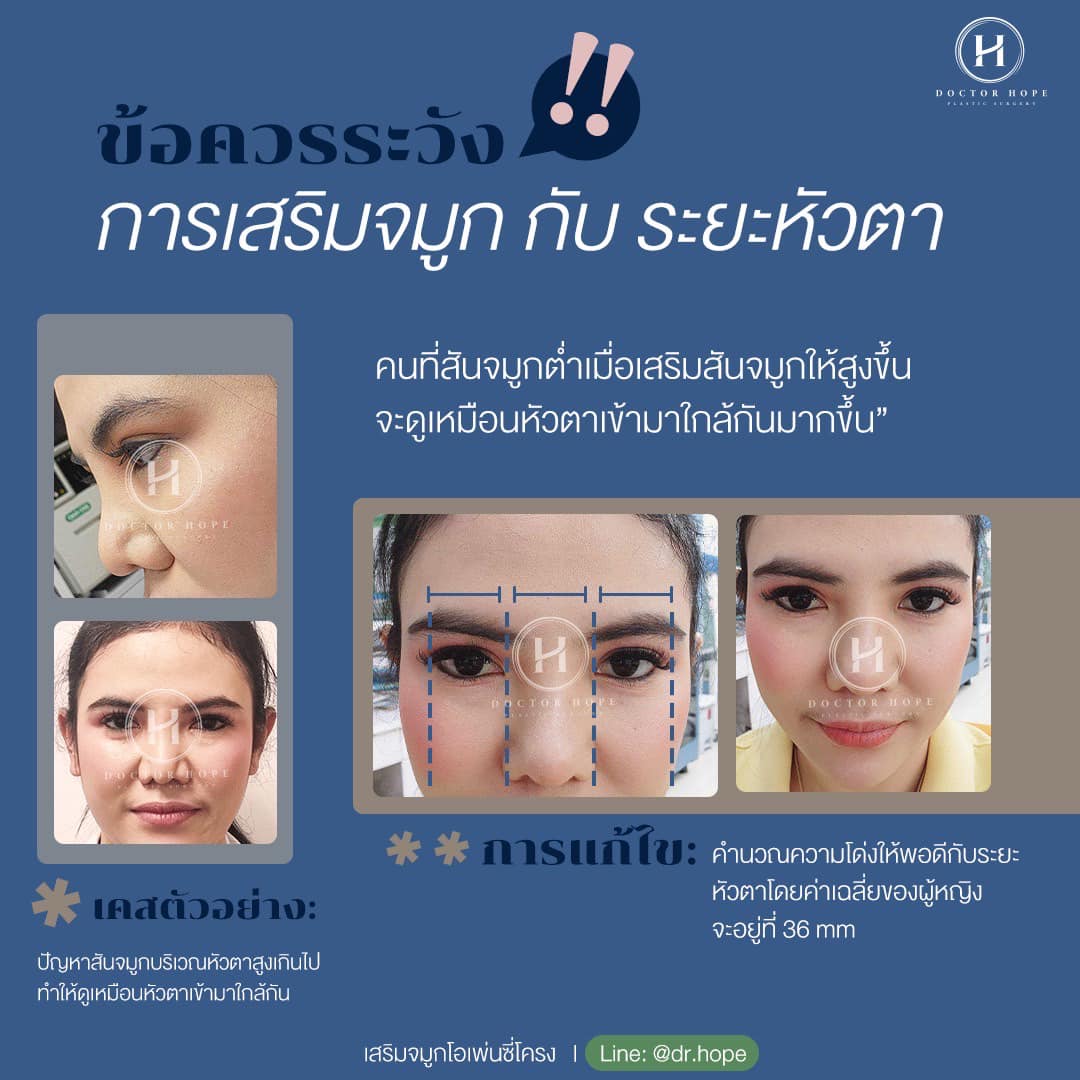 ข้อควรระวัง การเสริมจมูก กับ ระยะหัวตา