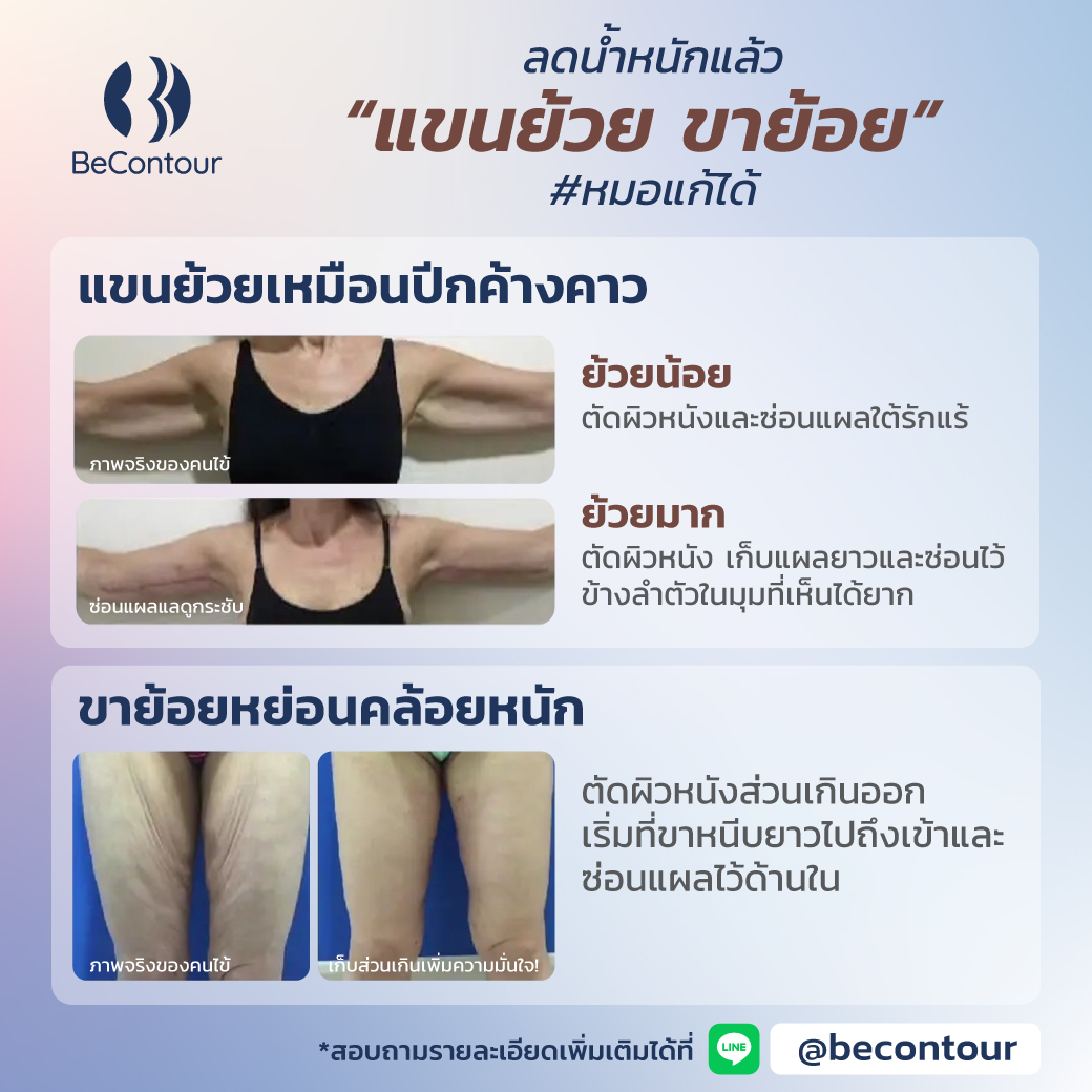 ปัญหา แขนขาย้วย หลังลดน้ำหนัก