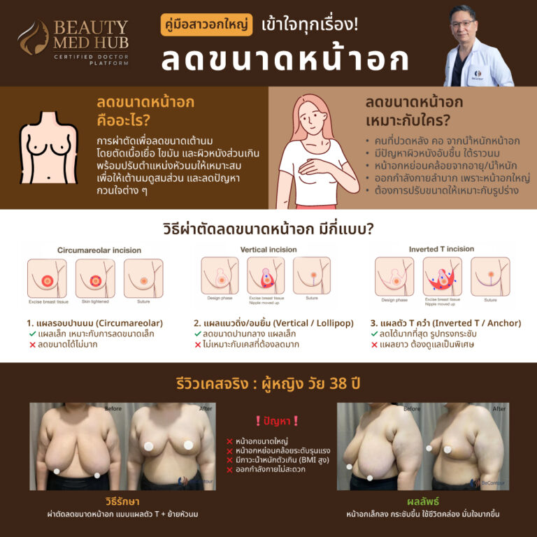 คู่มือสาวอกใหญ่ ลดขนาดหน้าอก