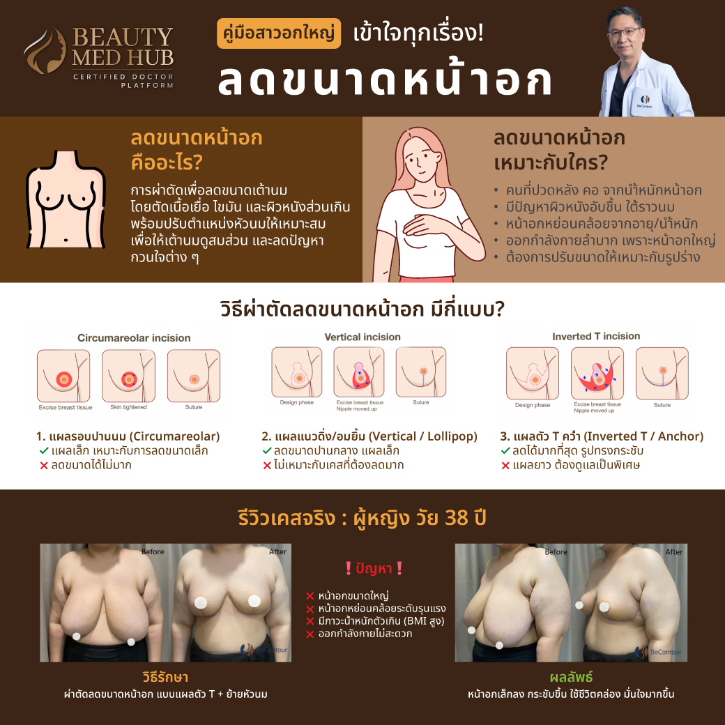คู่มือสาวอกใหญ่ ลดขนาดหน้าอก