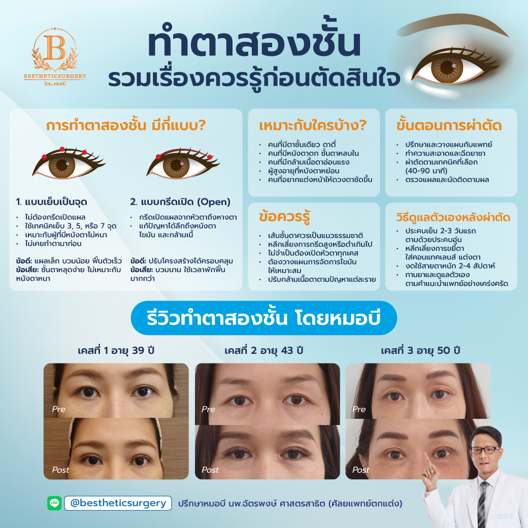 รวมเรื่องควรรู้ ก่อนตัดสินใจ “ทำตาสองชั้น” มีกี่แบบ? เหมาะกับใคร?