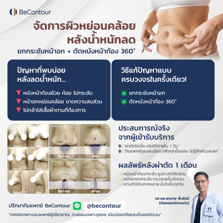 ยกกระชับหน้าอก + ตัดหนังหน้าท้อง 360° วิธีจัดการผิวหย่อนคล้อย หลังน้ำหนักลด