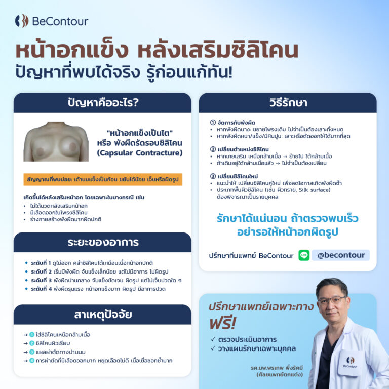 พังผืดรัดซิลิโคน หน้าอกแข็งเป็นไต หลังเสริมหน้าอก