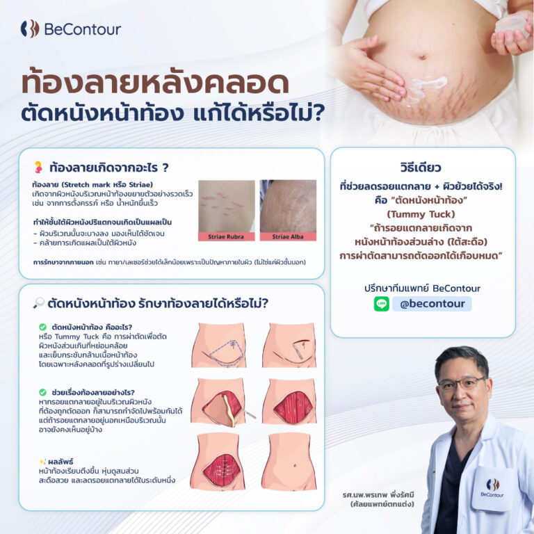 ท้องลายหลังคลอด ตัดหนังหน้าท้องแก้ได้จริงไหม?