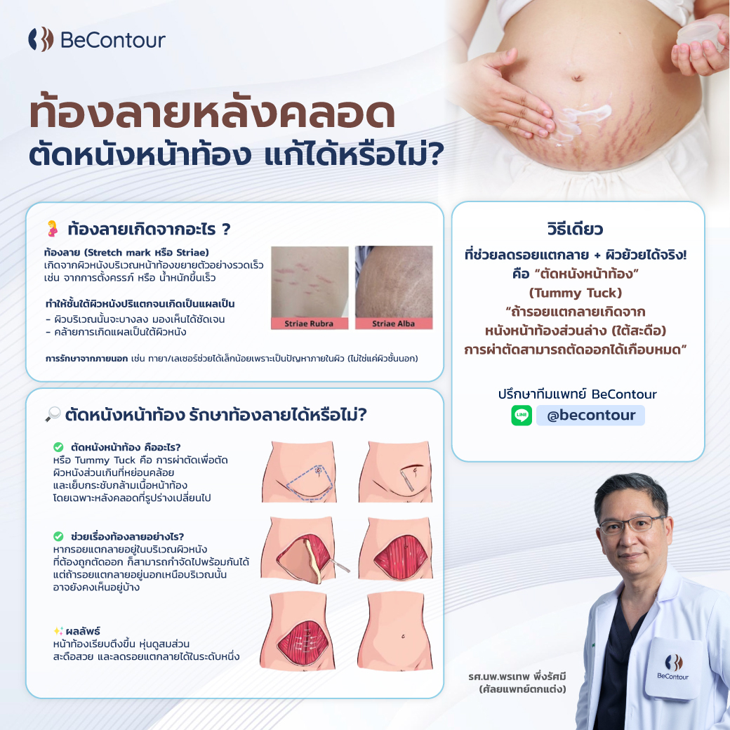 ท้องลายหลังคลอด ตัดหนังหน้าท้องแก้ได้จริงไหม?