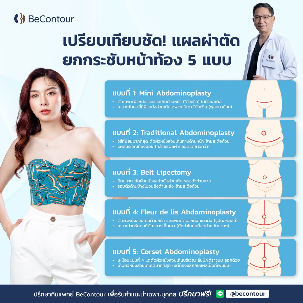 แผลผ่าตัด ยกกระชับหน้าท้อง มีแบบไหนบ้าง?