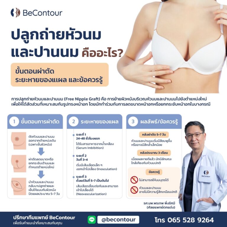 ปลูกถ่ายหัวนมและปานนม Free Nipple Graft คืออะไร?