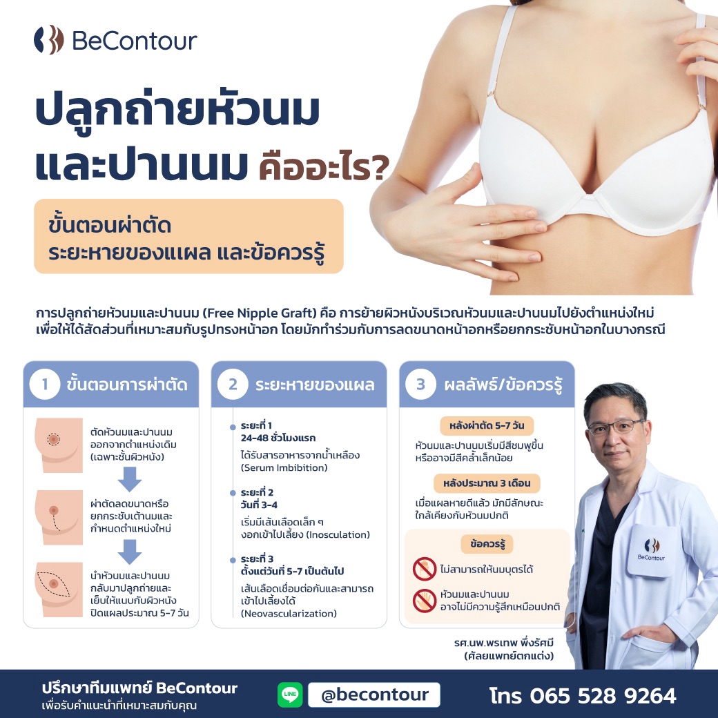 ปลูกถ่ายหัวนมและปานนม Free Nipple Graft คืออะไร?